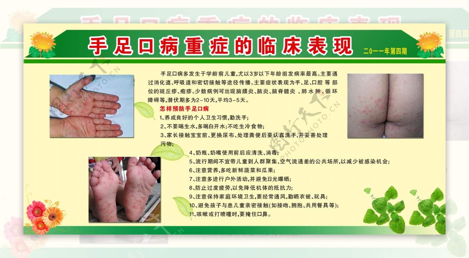 手足口病重症临床表现图片