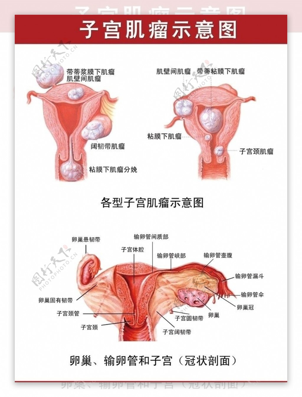 子宫肌瘤示意图图片