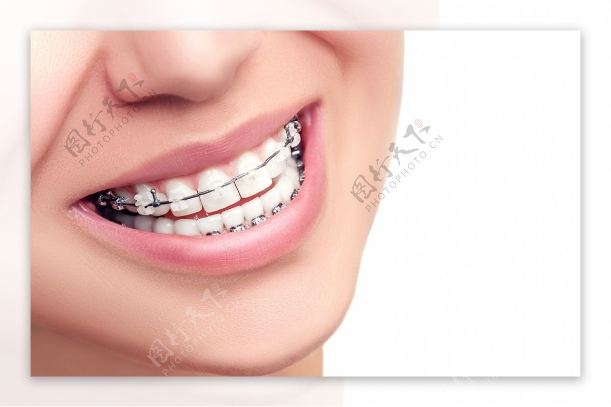 歯列矯正で唇の形は変わる？唇の形に変化が起きやすい歯並び6選 | アットスマイル矯正