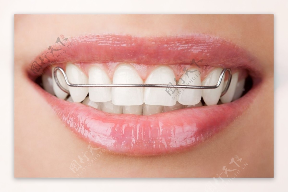 3大種類箍牙固定器、佩戴時間及清潔貼士一覽 - Dr Clear Aligners